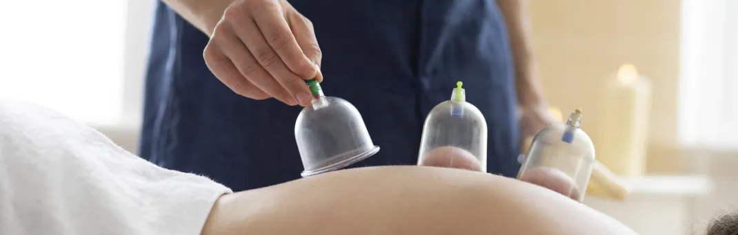 Cupping therapy for back pain relief. Physical therapy rehab treatment to improve mobility and function at our clinic.