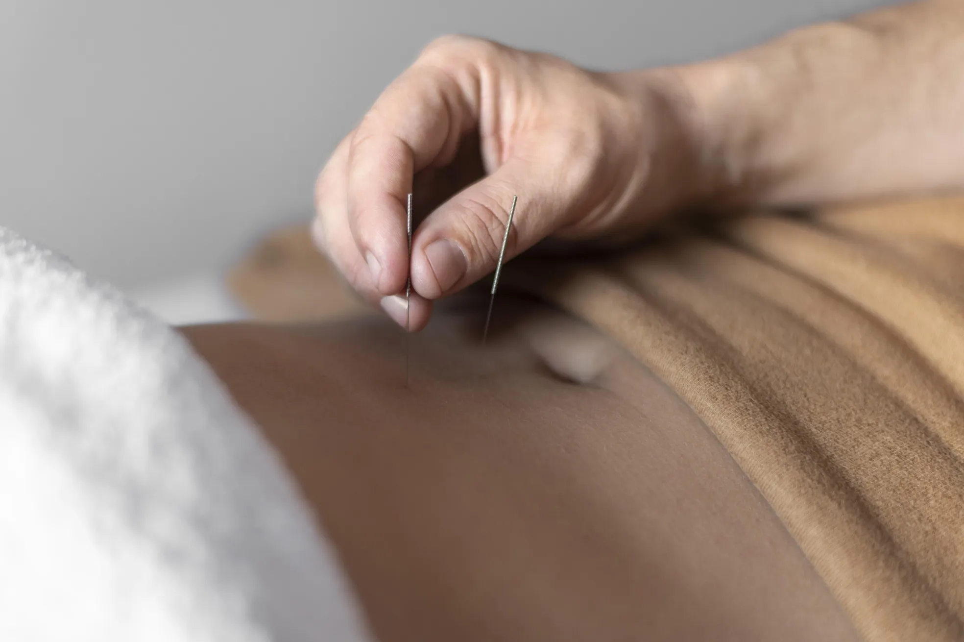 Dry needling therapy for pain relief. Patient receiving rehab treatment at physical therapy clinic to improve mobility.